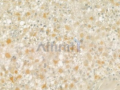 MRPL21 Antibody - DF3664 at 1/100 staining human astrocytoma by IHC-P.