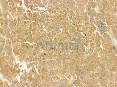 MRPL51 Antibody - DF3674 at 1/100 staining human hepatocellular carcinoma by IHC-P.