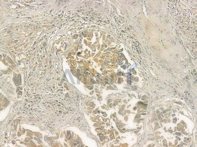 MRPL51 Antibody - DF3674 at 1/100 staining human lung squamous cell carcinoma by IHC-P.