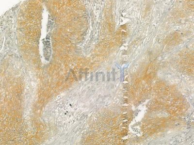 AZI1 Antibody - DF3692 at 1/100 staining human cervical carcinoma by IHC-P.
