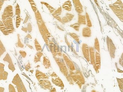 AZI1 Antibody - DF3692 at 1/100 staining human tongue carcinoma by IHC-P.