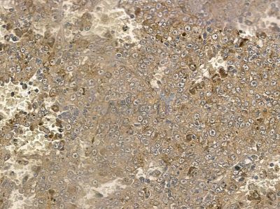 AGXT2L2 Antibody - DF3750 at 1/100 staining human liver cancer by IHC-P.