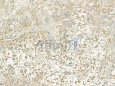 ALDH3B1 Antibody - DF3754 at 1/100 staining human hepatocellular carcinoma by IHC-P.