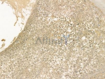 AOX1 Antibody - DF3756 at 1/100 staining human hepatocellular carcinoma by IHC-P.