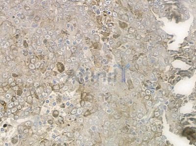 ABCB7 Antibody - DF3812 at 1/100 staining human melanoma by IHC-P.