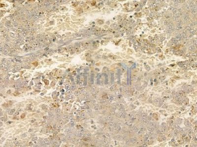 EPB41L2 Antibody - DF3826 at 1/100 staining human melanoma by IHC-P.