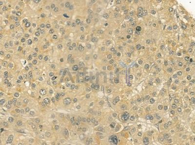 GCNT7 Antibody - DF3832 at 1/100 staining human hepatocellular carcinoma by IHC-P.