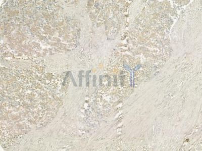 BCAS4 Antibody - DF3856 at 1/100 staining human prostate carcinoma by IHC-P.