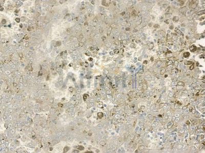 CABP7 Antibody - DF3863 at 1/100 staining human melanoma by IHC-P.