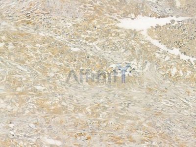 ABCC3 Antibody - DF3874 at 1/100 staining human lung squamous cell carcinoma by IHC-P.