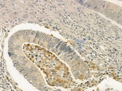 CTDSP1 Antibody - DF3902 at 1/100 staining human colon carcinoma by IHC-P.