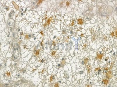 CEP170 Antibody - DF3917 at 1/100 staining human thyroid carcinoma by IHC-P.