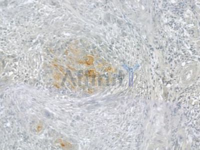 CEP78 Antibody - DF3922 at 1/100 staining human tongue carcinoma by IHC-P.