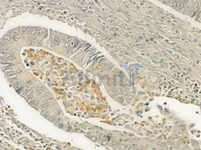 CLN6 Antibody - DF3928 at 1/100 staining human colon carcinoma by IHC-P.