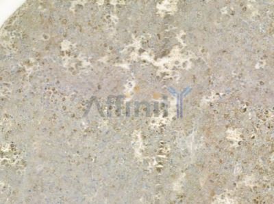 CLIC3 Antibody - DF3935 at 1/100 staining human melanoma by IHC-P.