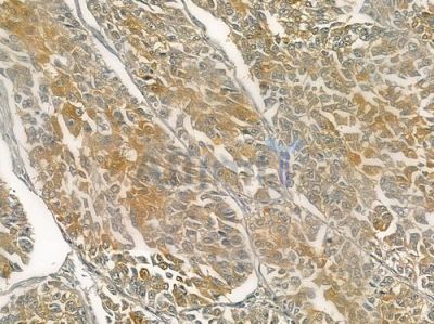 Claudin 6 Antibody - DF3946 at 1/100 staining human lung squamous cell carcinoma by IHC-P.