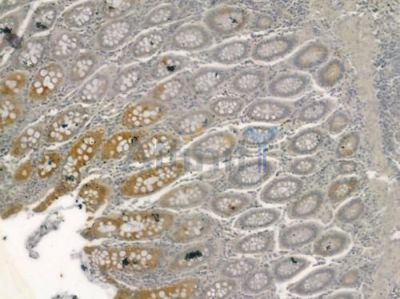 COPZ1 Antibody - DF3952 at 1/100 staining human colon carcinoma by IHC-P.