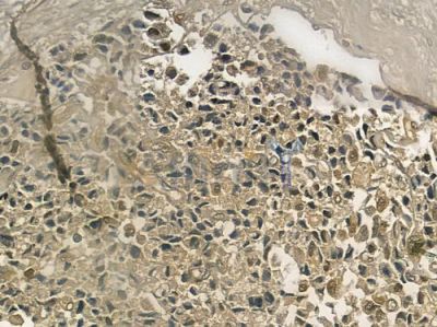 CBCP2 Antibody - DF3980 at 1/100 staining human prostate carcinoma by IHC-P.