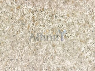 MARCH3 Antibody - DF4019 at 1/100 staining human thyroid carcinoma by IHC-P.
