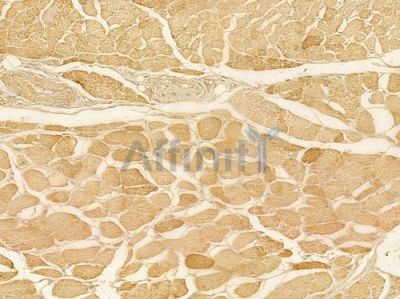MYLIP Antibody - DF4020 at 1/100 staining human tongue carcinoma by IHC-P.