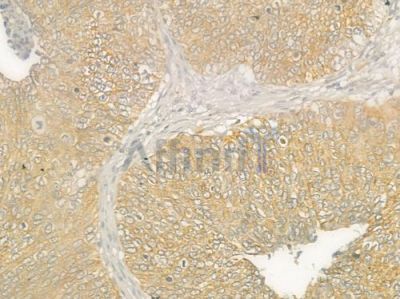 EFEMP2 Antibody - DF4033 at 1/100 staining human cervical carcinoma by IHC-P.