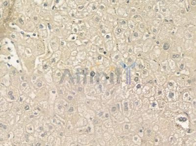 ELOVL5 Antibody - DF4038 at 1/100 staining human hepatocellular carcinoma by IHC-P.