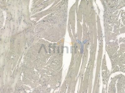 EIF3F Antibody - DF4053 at 1/100 staining human tongue carcinoma by IHC-P.