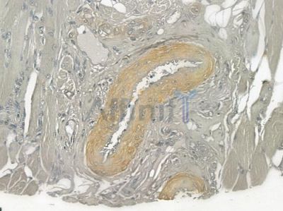 EIF3D Antibody - DF4054 at 1/100 staining human tongue carcinoma by IHC-P.