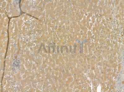 TUBGCP6 Antibody - DF4077 at 1/100 staining human hepatocellular carcinoma by IHC-P.