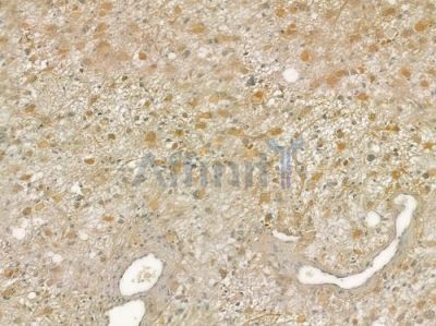 POFUT1 Antibody - DF4084 at 1/100 staining human thyroid carcinoma by IHC-P.