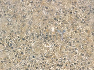GIMAP5 Antibody - DF4102 at 1/100 staining human hepatocellular carcinoma by IHC-P.