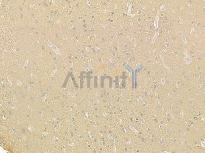 MRPL49 Antibody - DF4177 at 1/100 staining human glioblastoma by IHC-P.