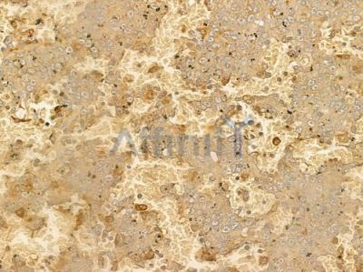 CYB5R3 Antibody - DF4212 at 1/100 staining human melanoma by IHC-P.