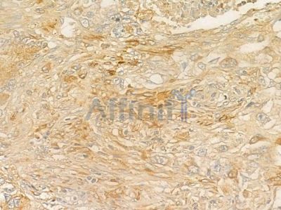 CYB5R3 Antibody - DF4212 at 1/100 staining human lung squamous cell carcinoma by IHC-P.