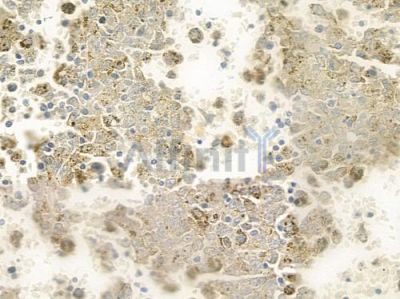 NEURL2 Antibody - DF4227 at 1/100 staining human melanoma by IHC-P.