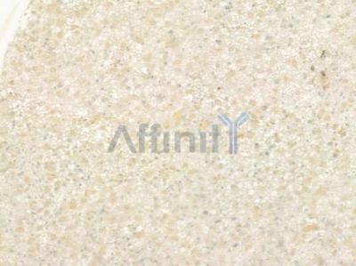 NMU Antibody - DF4238 at 1/100 staining human astrocytoma by IHC-P.