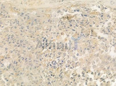 S100A16 Antibody - DF4353 at 1/100 staining human prostate carcinoma by IHC-P.