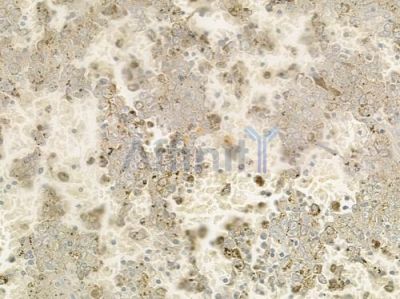 RAB2A Antibody - DF4399 at 1/100 staining human melanoma by IHC-P.
