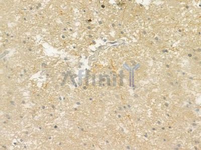 RAB37 Antibody - DF4403 at 1/100 staining human glioblastoma by IHC-P.