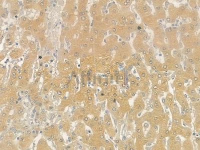 ARHGEF10 Antibody - DF4430 at 1/100 staining human hepatocellular carcinoma by IHC-P.