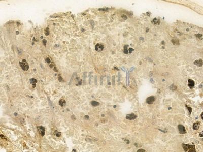 PDIK1L Antibody - DF4469 at 1/100 staining human melanoma by IHC-P.