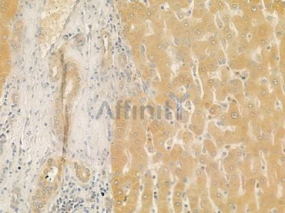 PPP2R1B Antibody - DF4484 at 1/100 staining human hepatocellular carcinoma by IHC-P.