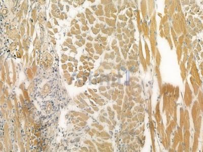 SLC28A2 Antibody - DF4522 at 1/100 staining human tongue carcinoma by IHC-P.