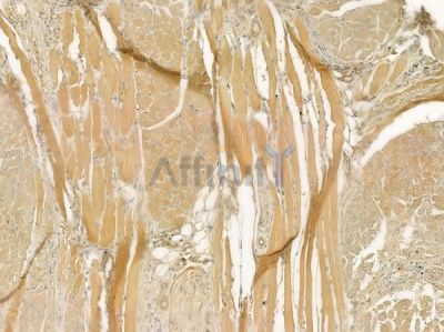 SLC28A2 Antibody - DF4522 at 1/100 staining human tongue carcinoma by IHC-P.