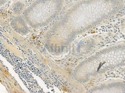 CCT6A Antibody - DF4562 at 1/100 staining human colon carcinoma by IHC-P.