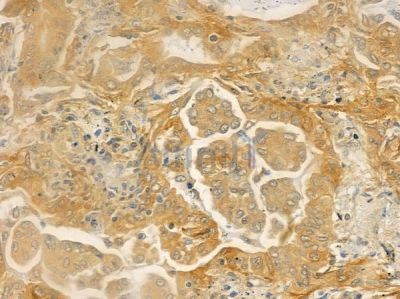 CCT6A Antibody - DF4562 at 1/100 staining human lung adenocarcinoma by IHC-P.