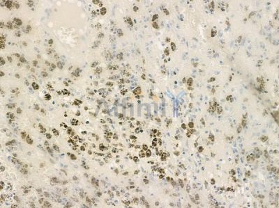 TIGD3 Antibody - DF4567 at 1/100 staining human melanoma by IHC-P.