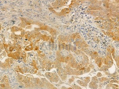 UEVLD Antibody - DF4602 at 1/100 staining human lung adenocarcinoma by IHC-P.