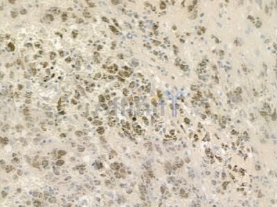 ZBTB40 Antibody - DF4620 at 1/100 staining human melanoma by IHC-P.