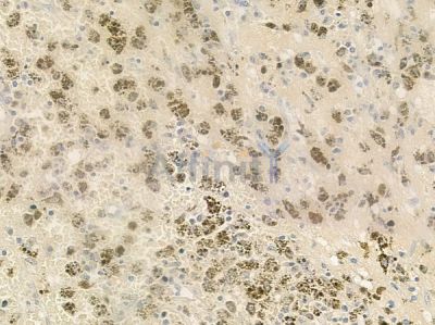 ZC3H8 Antibody - DF4624 at 1/100 staining human melanoma by IHC-P.